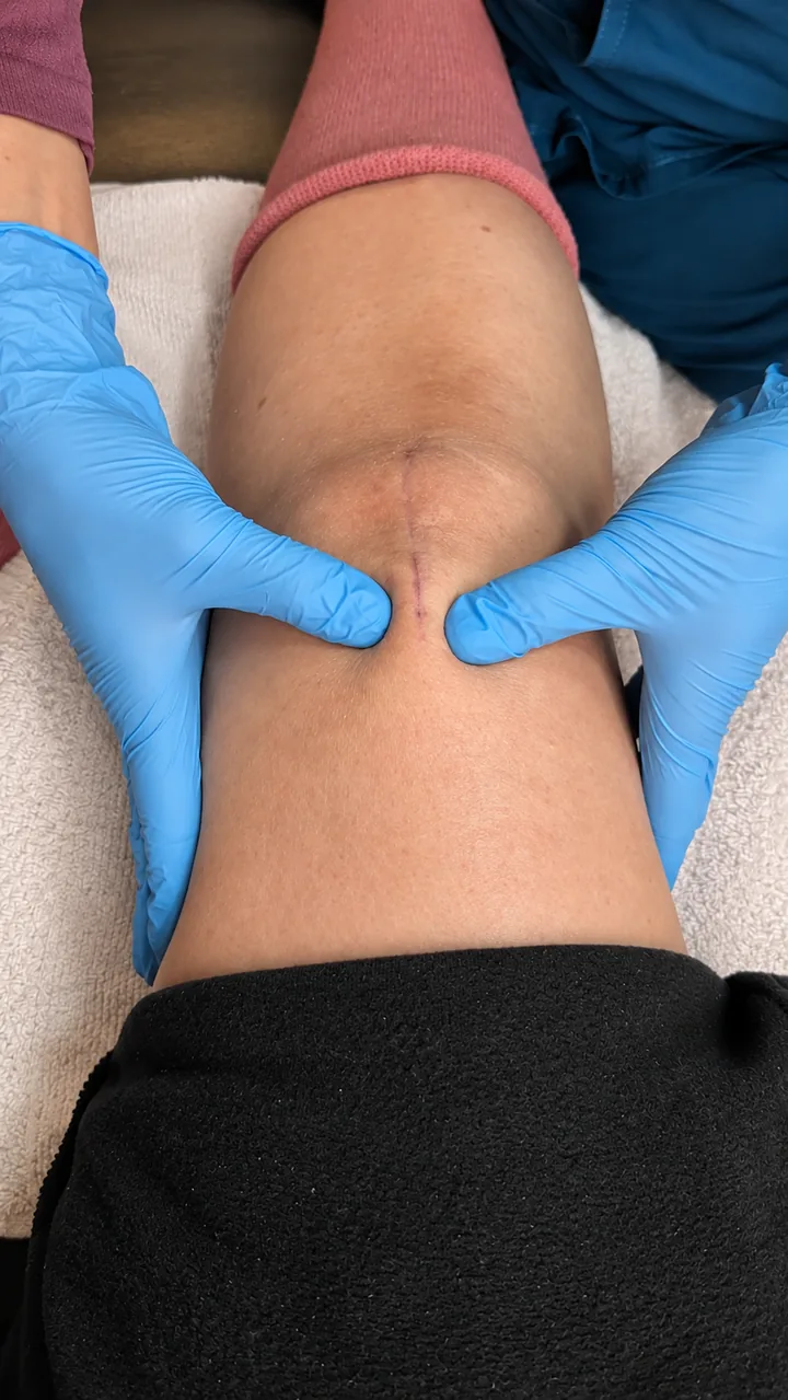 Evaluación kinésica de una cicatriz postquirúrgica en la rodilla