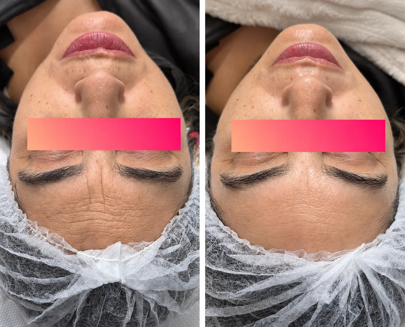 Comparación de la piel facial antes y después de una limpieza